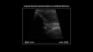 Acetabular labral tear on hip ultrasound case 2 [upl. by Enoitna]