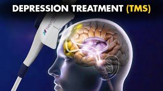 How Transcranial Magnetic Stimulation TMS Is Performed To Treat Depression [upl. by Corabelle]