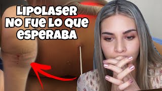 LASER LIPOLISIS FUNCIONA MI EXPERIENCIA PARTE 1 [upl. by Amie882]