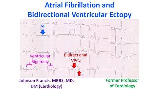 Atrial Fibrillation and Bidirectional Ventricular Ectopy [upl. by Annaili]