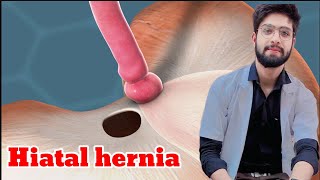 Hiatus hernia anatomy more [upl. by Ehrman40]