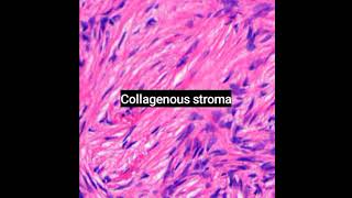 Histopathology of Dermatofibrosarcoma protuberans dermpath dermatopathology shorts [upl. by Malkah950]