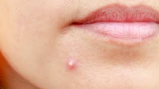 What Causes Acne [upl. by Libb]