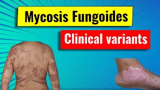 Clinical variants of Mycosis fungoides MF [upl. by Ankney]