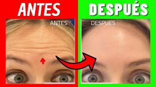 ✅ Mitos y Verdades del BÓTOX  ▶️ ANTES Y DESPUÉS del BÓTOX 👨🏻‍⚕️ [upl. by Butler263]