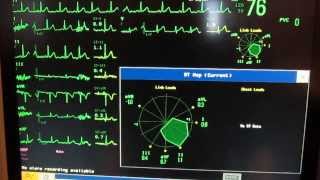 IntelliVue ST Map multiple ECG [upl. by Hannie]