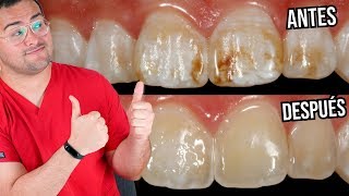 FLUOROSIS DENTAL ¿Como QUITAR estas MANCHAS de los DIENTES ¡SI SE PUEDE 🙌 [upl. by Spiegel]