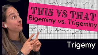 Bigeminy vs Trigeminy 🫀 [upl. by Aire]