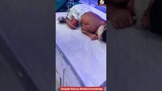 Newborn baby jaundice treatment by phototherapynewborn jaundice phototherapy [upl. by Tabbi163]