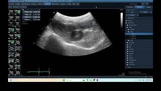 IQ 280 LIVER HEPATOMA ULTRASOUND ECHOPAC ANALYSIS C15RS probe [upl. by Schreib]