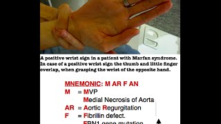 Marfan Syndrome Mnemonic [upl. by Freemon902]