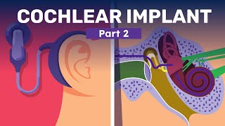 Are You Eligible for Cochlear Implants [upl. by Ydnec]