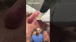 Watch this pore spatula in action 🍴credit basemkhaled123 on TT doctor satisfying viral [upl. by Bottali656]