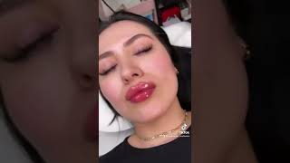 Our Signature Lips using different lip filler techniques fanning and tenting technique [upl. by Ravo]