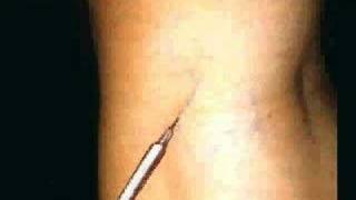 Tratamiento esclerosante de varices  Sclerosing Treatment of Varicose Veins  Sclerotherapy [upl. by Roer311]