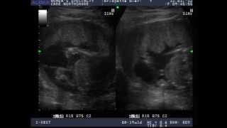 1920 Week Ultrasound of Baby Boy Biernacki [upl. by Avik]