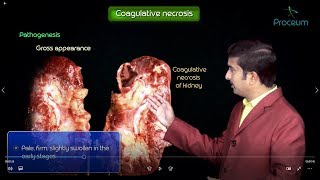 Necrosis and types of Necrosis  General pathology  Animated usmle videos [upl. by Shreeves]