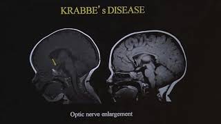 TMT Neuroradiology by Dr Deepak Patkar Ped White Matter Diseases  II [upl. by Annola]