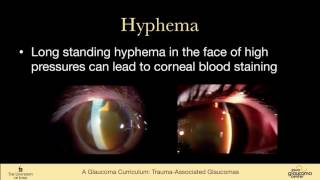 26 SECONDARY GLAUCOMAS Trauma associated Glaucomas Angle Recession hyphema Ghost Cell Siderosis [upl. by Yttel]