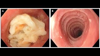 Eosinophile Ösophagitis [upl. by Elag6]