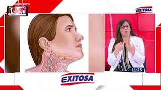 GANGLIOS  DRA ANA BURGA CIRUJANA DE CABEZA Y CUELLO HEVES [upl. by Clotilde]