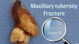 كسر ال maxillary tuberosity أثناء خلع ال Upper 8 هتتعامل ازاي ؟ [upl. by Lissak743]