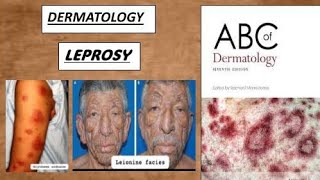 DERMATOLOGY  LEPROSY tuberculoid amp lepromatous derma lesion leprosy [upl. by Horton]