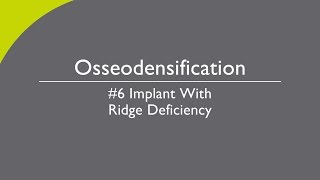 Osseodensification 6 Implant with Ridge Deficiency [upl. by Jinny]