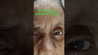 ENTROPION CASEOPHTHALMOLOGY PATIENT ENTROPIONCLINICAL CASE ENTROPIONEYELASHES PROBLEM [upl. by Mulford223]