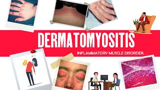 Dermatomyositis  Inflammatory muscle disease  definition causes skin lesion radiology amp treatment [upl. by Juta]