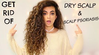 HOW TO GET RID OF DRY SCALPPSORIASIS [upl. by Accire75]