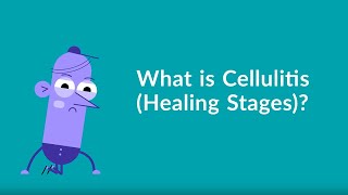 Cellulitis Healing Stages [upl. by Nilesoy]