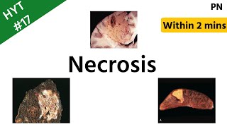 Necrosis  Types of Necrosis  Pathology  HYT 17  NEETPG  INICET [upl. by Otho]