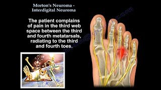 Mortons Neuroma  Interdigital Neuroma  Everything You Need To Know  Dr Nabil Ebraheim [upl. by Acireed240]