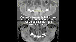 Anterior Open Bite Following Bilateral Condylar Fractures Why does it occur and how is it treated [upl. by Duwalt]