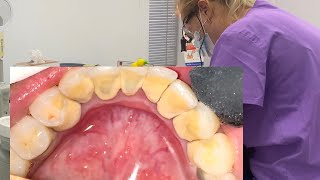 Professional teeth cleaning  removal tartar  scaling teeth [upl. by Eerazed14]