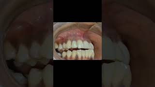 Upper lateral incisor implant crown protrusion inference checking video shorts [upl. by Gaven221]