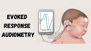 Electrocochleography and Auditory Brainstem Response In easy words  Evoked Response Audiometry [upl. by Naesed]