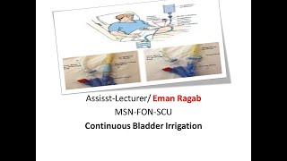 continous bladder irrigation Practical Part 3 [upl. by Eelrahc]