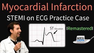 Myocardial Infarction  STEMI on ECG  Practice EKG [upl. by Nitas805]