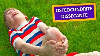 OSTEOCONDRITE DISSECANTE DO JOELHO [upl. by Assilav]