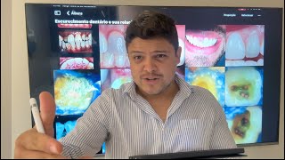 Escurecimento dentário e sua relação com a endodontia [upl. by Anikahs741]