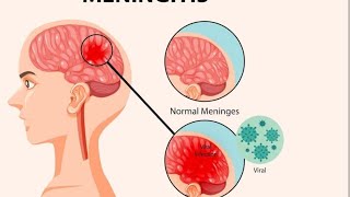 Meningitis what you need to know short fyp howto [upl. by Mundford]