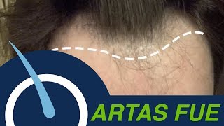 Hair Transplant to restore Receding Hairline [upl. by Lleroj]