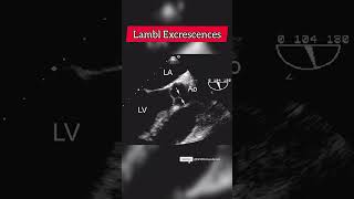 Lambl excrescences heart Echocardiogram aorticvalve [upl. by Clifton452]