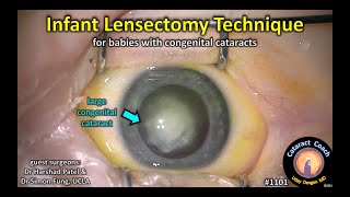 CataractCoach 1101 infant lensectomy for baby with congenital cataracts [upl. by Bridgid]