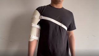 Humeral Fracture Splint for Broken Humerus [upl. by Brew]