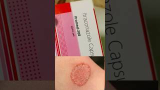 Itraconazole capsule  Itraconazole 100mg  shorts shortvideo ytshorts skincare fungalinfection [upl. by Yenattirb]