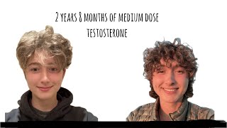 Non Binary HRT Journey Over 25 Years on quotMediumquot Dose Testosterone [upl. by Eitsym836]