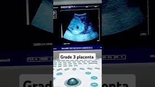 Grade 3 placenta localization at Anterior side ultrasound fetalheartshortvideo foryou [upl. by Ahsenyl129]